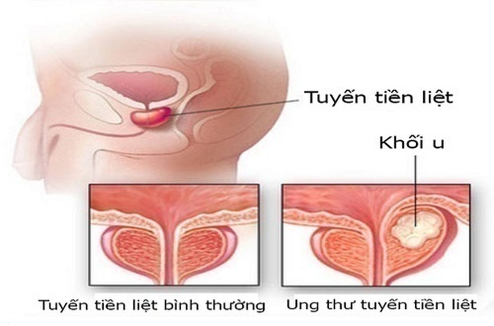 3 xét nghiệm cần làm để chẩn đoán ung thư tiền liệt tuyến - 1 3 xét nghiệm cần làm để chẩn đoán ung thư tiền liệt tuyến - 1