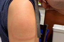 Hỏi đáp vắc xin: Điều trị "Cánh tay Covid" có giảm hiệu quả vắc xin?