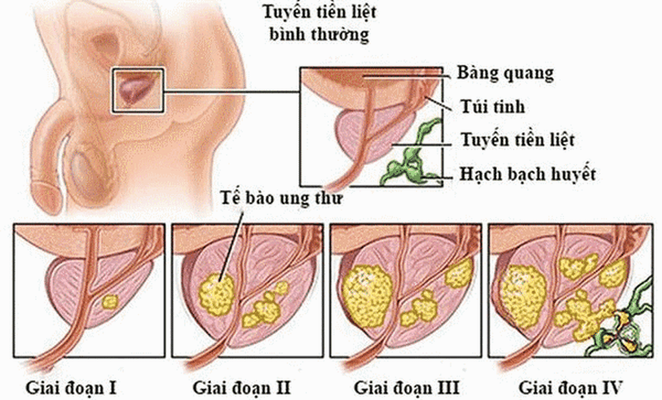 Ung thư tuyến tiền liệt không còn đáng sợ - 1 Ung thư tuyến tiền liệt không còn đáng sợ - 1