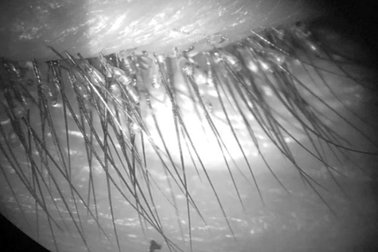 Bác sĩ tá hỏa vì hàng trăm con rận mu, trứng rận trên mi mắt bệnh nhân