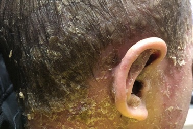 Cậu bé “người cóc” đau đớn vì sần sùi, bong vảy toàn thân