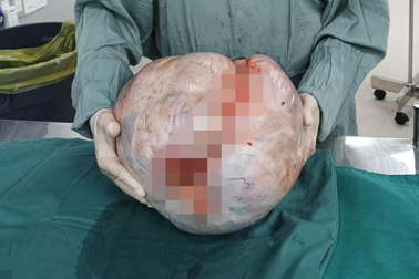 Uống thuốc nam trị "bụng to", người phụ nữ gánh khối u 15kg ở buồng trứng