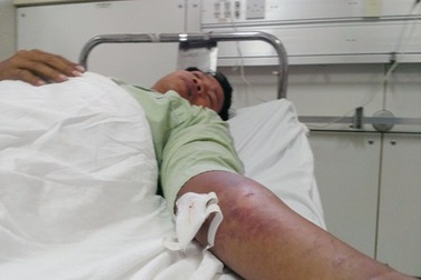 Sơ cứu, điều trị kịp thời sẽ giảm tử vong do rắn độc cắn