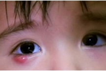 Cảnh báo: Nhiều trẻ phải vào bệnh viện nhi đồng ở TPHCM vì bị chắp lẹo mắt