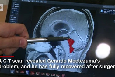 Nhức đầu đến nôn mửa vì…sán dây “trú ngụ” trong nãoNhức đầu đến nôn mửa vì…sán dây “trú ngụ” trong não