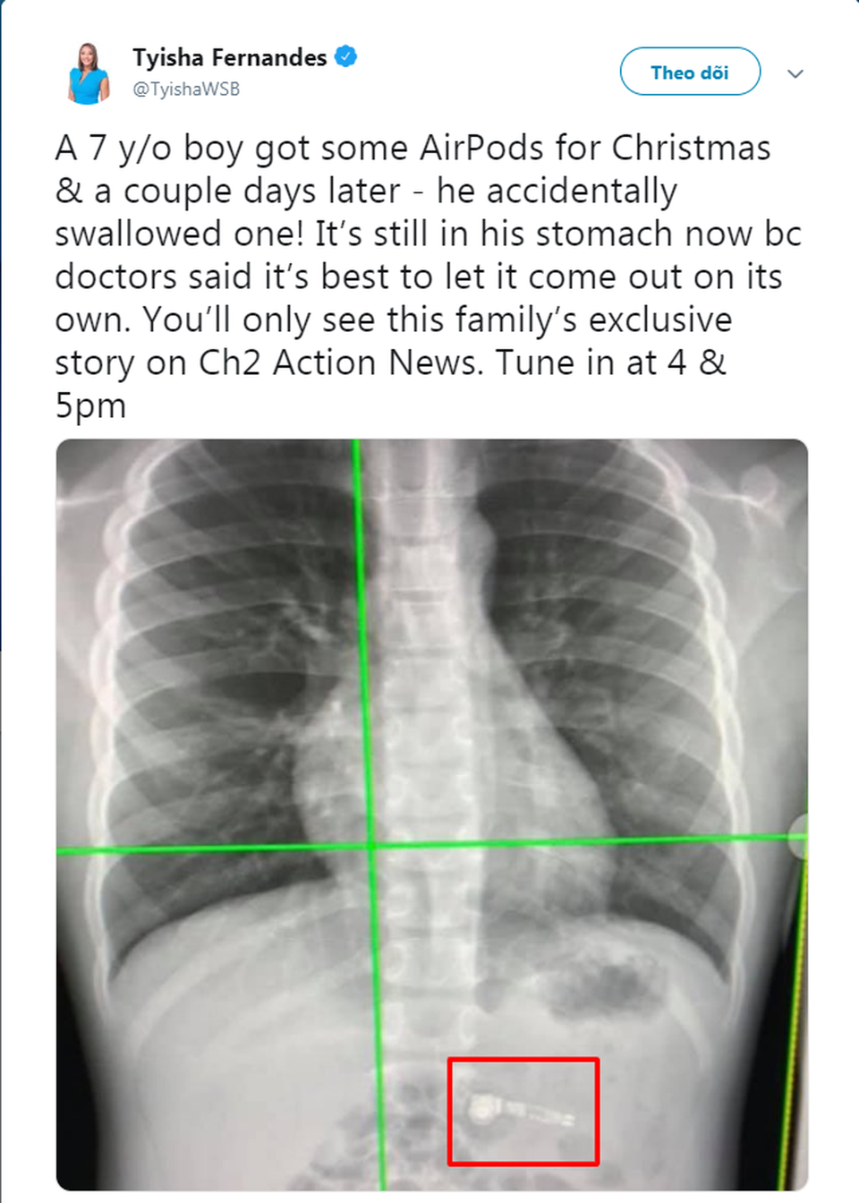 Bà mẹ hốt hoảng khi con trai 7 tuổi nuốt chửng tai nghe AirPods - 2 Bà mẹ hốt hoảng khi con trai 7 tuổi nuốt chửng tai nghe AirPods - 2