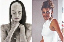 Cảm động trước nghị lực sống phi thường của hoa hậu bị bỏng 85% cơ thể