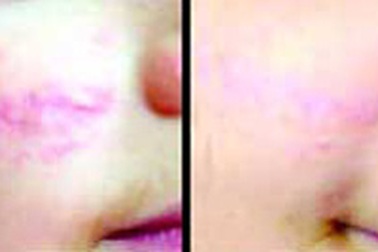 Điều trị sẹo lồi bằng laser PDL