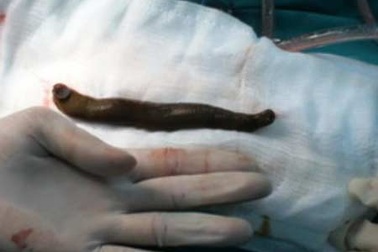 Gắp con đỉa 20cm trong bàng quang thiếu niên