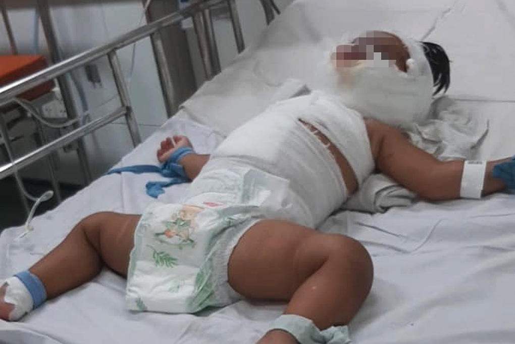 TPHCM: Bé gái 1 tuổi bỏng thương tâm vì ngã vào nồi nước sôi mẹ nấu - 1 TPHCM: Bé gái 1 tuổi bỏng thương tâm vì ngã vào nồi nước sôi mẹ nấu - 1