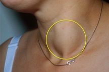 Dấu hiệu nhận biết loại ung thư tuyến giáp thường gặp ở phụ nữ 30 - 50 tuổi