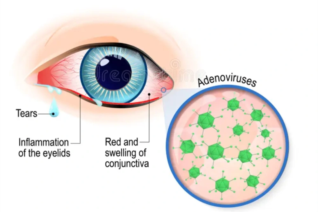 TPHCM xác định 2 loại virus gây bệnh đau mắt đỏ cho hàng loạt người dân - 2