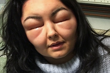 Mặt sưng vù sau 2 lần... nhuộm tóc