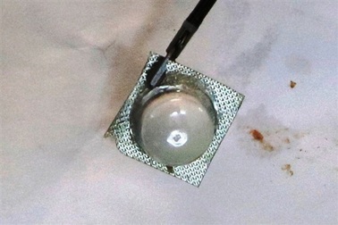 Cụ ông 96 tuổi nuốt viên thuốc còn nguyên vỉ sắt