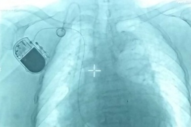 Bệnh viện tuyến quận đầu tiên cấy được máy tạo nhịp tim