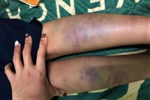 Học sinh lớp 1 bầm tím chân khi ở trường: Không phải do giáo viên hành hung