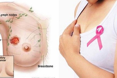 Điều trị ung thư vú tái phát