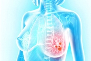 Thuốc mới giúp kéo dài sự sống cho bệnh nhân ung thư vú