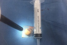 Viên thuốc nguyên vỏ nằm trong khí quản người đàn ông suốt 3 năm