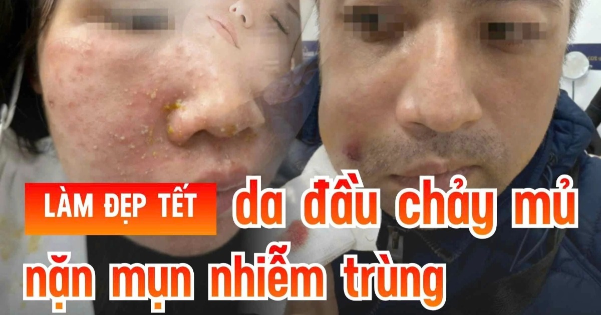 Lệch mặt, cháy da, nhiều chị em suýt “mất Tết” vì dịch vụ làm đẹp cấp tốc