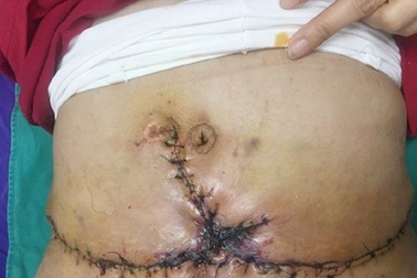 Hoại tử nặng vì hút mỡ bụng giảm béo