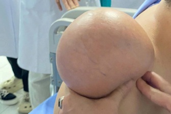 Người đàn ông "gánh" khối u khổng lồ trên vai suốt 5 năm