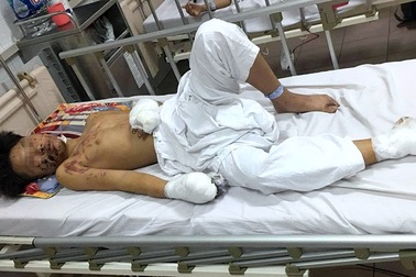 Tự chế pháo, thiếu niên 15 tuổi bị thương tích nặng