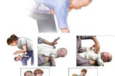 Việc cần làm ngay khi trẻ hóc dị vật