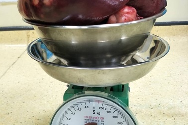 Bác sĩ rùng mình cắt khối u khổng lồ nặng gấp 11 lần trọng lượng của lá lách