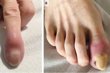 Người đàn ông bất ngờ phát hiện bị "ăn mất" ngón tay sau 6 tuần sưng đỏ