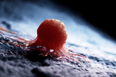 Đâu là loại ung thư phổ biến nhất?