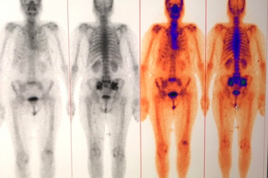 Xạ hình xương - Phương pháp chẩn đoán ung thư di căn xương