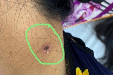 Người phụ nữ bị suy gan, hôn mê chỉ vì một vết đốt ở cổ