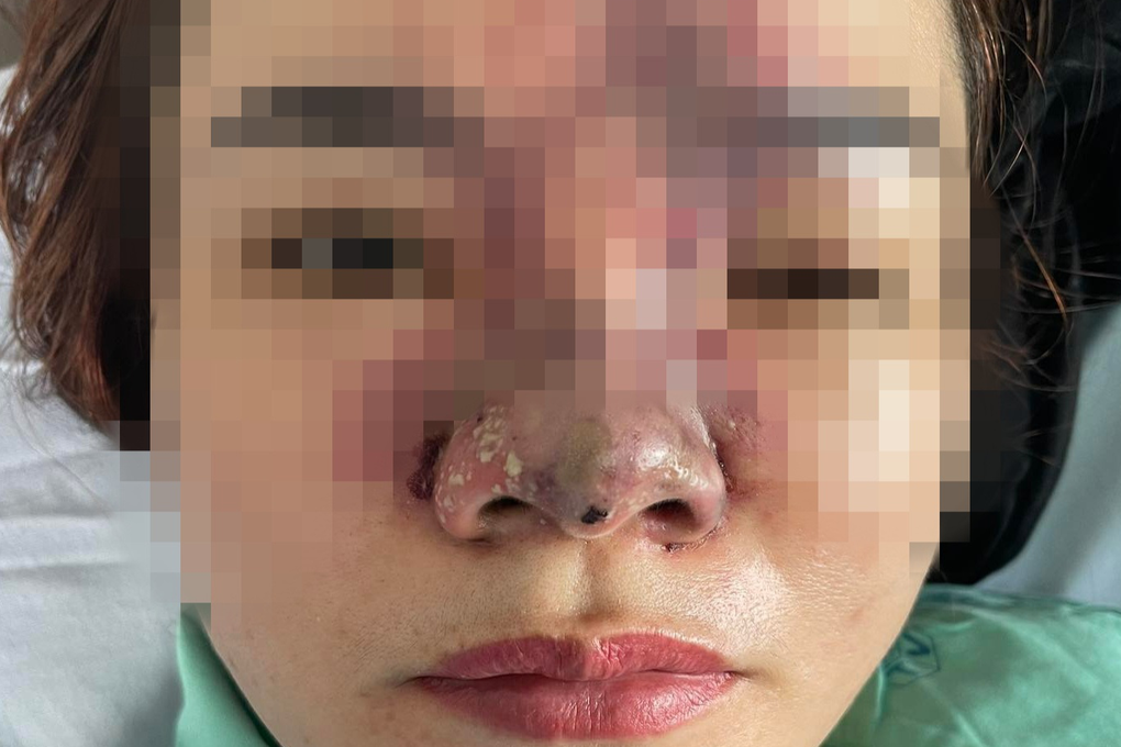 Người phụ nữ 39 tuổi mù mắt sau khi tiêm filler tại hộ Hồng Cúc ở TPHCM - 2 Người phụ nữ 39 tuổi mù mắt sau khi tiêm filler tại hộ Hồng Cúc ở TPHCM - 2