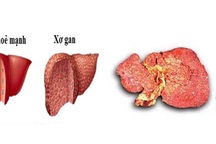 5 thủ phạm chính khiến nhiều người Việt mắc ung thư gan