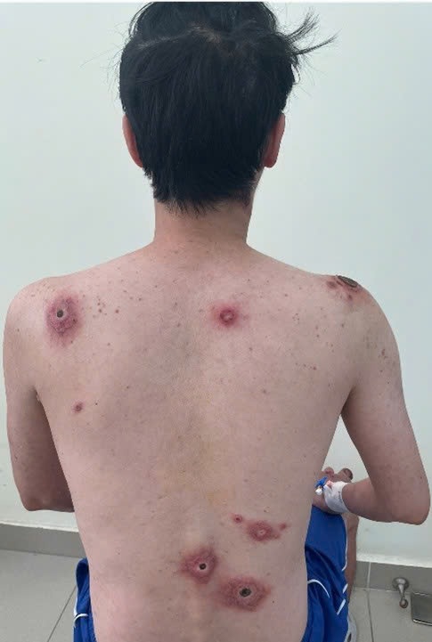 Xuất hiện nhiều vết loét trên lưng sau lần vượt rào không an toàn - 1