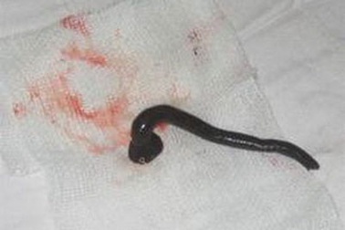 Gắp con đỉa dài 3cm sống trong phế quản