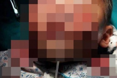 Chơi cạnh 2 con chó, bé trai bị cắn nát mặt