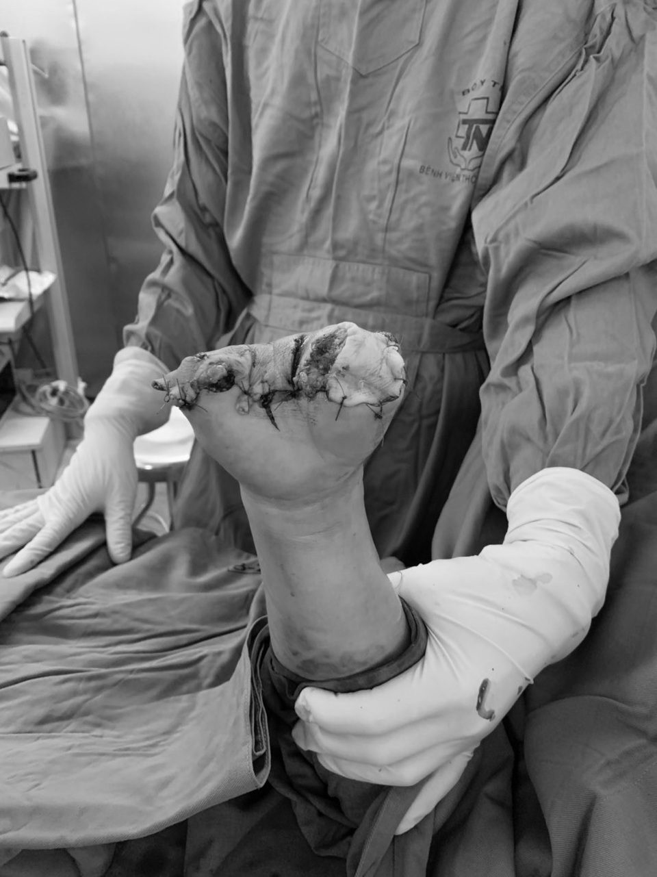 Bác sĩ dùng cưa sắt giải cứu bàn tay bị máy xay thịt nuốt chửng - 3 Bác sĩ dùng cưa sắt giải cứu bàn tay bị máy xay thịt nuốt chửng - 3