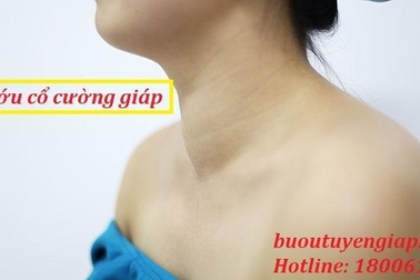 Bướu cổ cường giáp và tất cả những điều bạn cần biết