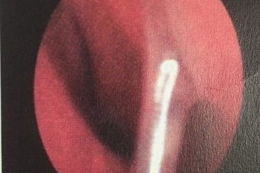 Đũa đâm sâu vào mũi, bé 3 tuổi bị viêm màng não nặng