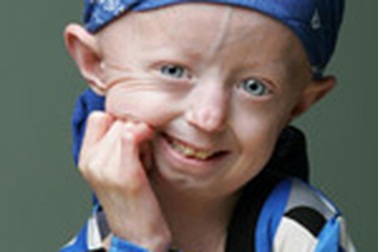 Em bé 9 tuổi có thân hình của bà lão 70