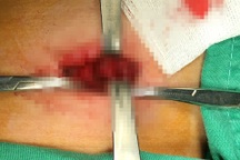 TPHCM: Cha cắt đá mài văng lưỡi cưa, con trai 8 tuổi đứt khí quản nguy kịch