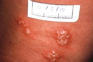 Mụn cóc sinh dục có liên quan với nhiều dạng ung thư