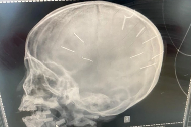 Vụ bé gái bị đóng 10 đinh vào đầu: 5 lần bị người tình của mẹ tra tấn