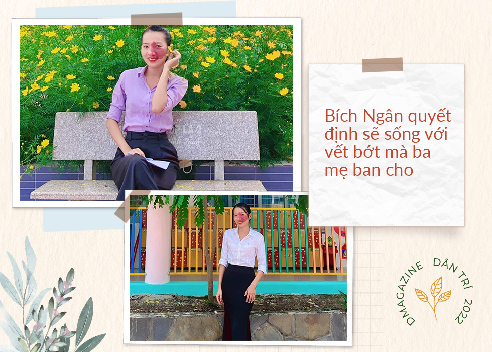 Cô giáo trẻ sống vui vẻ, tự tin với vết bớt chiếm một phần tư gương mặt - 3 Cô giáo trẻ sống vui vẻ, tự tin với vết bớt chiếm một phần tư gương mặt - 3