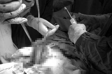 TPHCM: Say khướt, cô gái 26 tuổi té vào thành cầu Ba Son vỡ lách nguy kịch