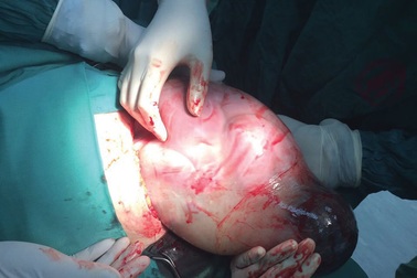 Hy hữu: Em bé chào đời còn nguyên trong túi ối