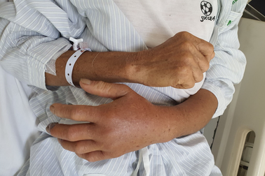 Người đàn ông sưng phù tay, hoại tử sau khi bị con rắn “tưởng đã chết” cắn