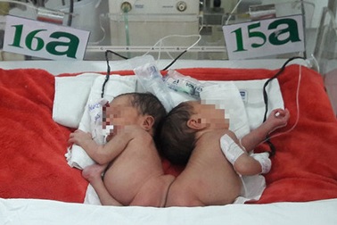 Vụ hai bé song sinh dính mông: Chất lượng cuộc sống sau phẫu thuật sẽ không tốt